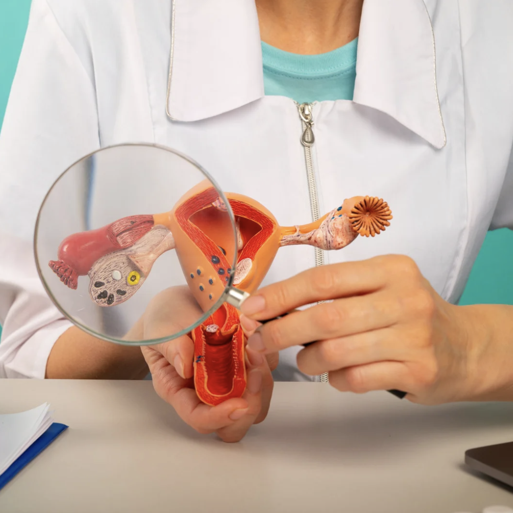 Alimentation et SOPK : quel lien réel… et comment l’utiliser pour aller mieux ?